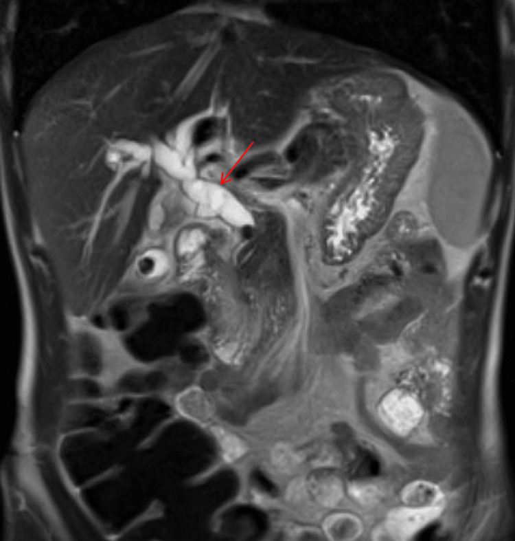MRCP (coronal view) with marked intrahepatic and extrahepatic biliary ductal dilatation caused by a group of stones within the distal common bile duct (red arrow). MRCP: magnetic resonance cholangiopancreatography