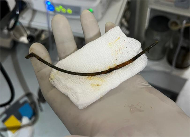 The stent after removal.