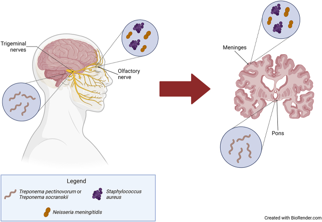 Bacteria translocation into the trigeminal and olfactory nerves of people with Alzheimer’s disease.