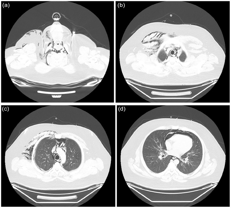 A set of four CT thorax images showing the progression of subcutaneous emphysema to pneumonectomy and pneumomediastinum.