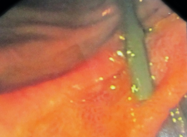 Endoscopic retrograde cholangiopancreaticography showing cannulation of the papilla