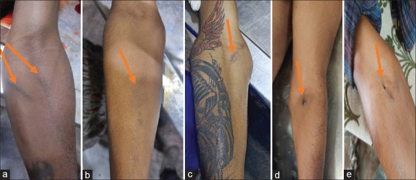 (a-e) Prominent cubital veins with injection marks noted over the Case no. 1, 2, 3, 6, 7. Arrow showing prominent cubital veins