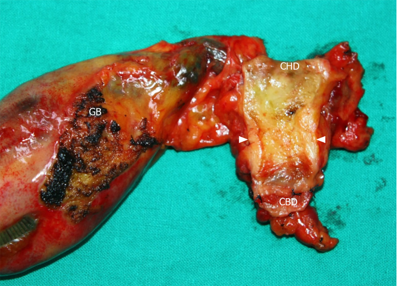 Gross findings of the specimen. The tumor is shown to be located around the cystic duct orifice and is grossly about 2-cm long. Depth of invasion of the tumor seems to reach the pericholedochal adipose tissue. CBD: Common bile duct; GB: Gallbladder; CHD: Common hepatic duct.