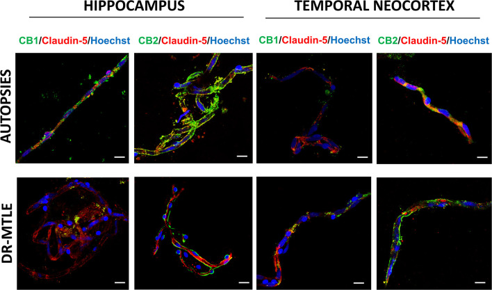 Double-labeling immunofluorescence staining of claudin-5 and CB1 or CB2 in MECs isolated from the hippocampus and temporal neocortex of non-epileptic autopsies and patients with DR-MTLE. Cell nuclei were stained with Hoechst (in blue). Notice the high claudin-5 staining colocalization with low (hippocampus) and high (temporal neocortex) CB1 and CB2 staining in MECs of patients with DR-MTLE. All scale bars are 20 μm.