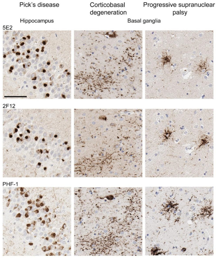 Immunohistochemical labelling of tau pathology in primary tauopathies. The hippocampus for Pick’s disease cases and the basal ganglia (striatum) for corticobasal degeneration and progressive supranuclear palsy cases were investigated for the presence of tau neuropathological lesions using novel antibodies 5E2 and 2F12, as well as phospho-dependent tau antibody PHF-1. For PiD, case PiD-1 is shown. For CBD, case CBD-4 is shown. For PSP, case PSP-6 is shown. Scale bar is 60 µm.