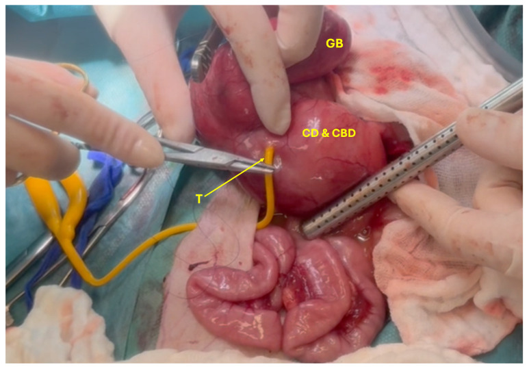 Placing of choledochostomy tube (T) in the cystic and common bile duct (CD and CBD) to empty CD, CBD and Gallbladder (GB).