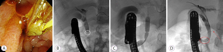 Squashed muddy stone from the common bile duct (CBD) is extracted by endoscopic balloon dilation (A). Endoscopic retrograde cholangiography shows dilated proximal bile ducts and a narrowing and a shelf-like linear contrast shadow (white circle) in the distal CBD (B). Balloon dilation of the bile duct is performed to dilate the orifice and stricture of the CBD (C). Cholangiography after CBD dilatation shows dilated stricture and a common channel (red circle) with the pancreatic duct (red arrow, D). Abnormal pancreaticobiliary junction is noted.