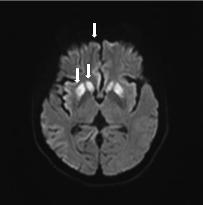 MRI with DWI image of the patient.