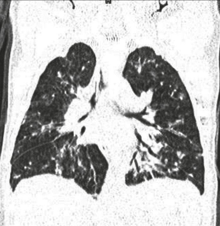 Bilateral perihilar consolidation with features of bronchiolitis and chronic lung disease.