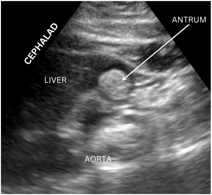 Example of gastric ultrasound image acquisition with gastric antrum visualized. Image originally acquired by authors.