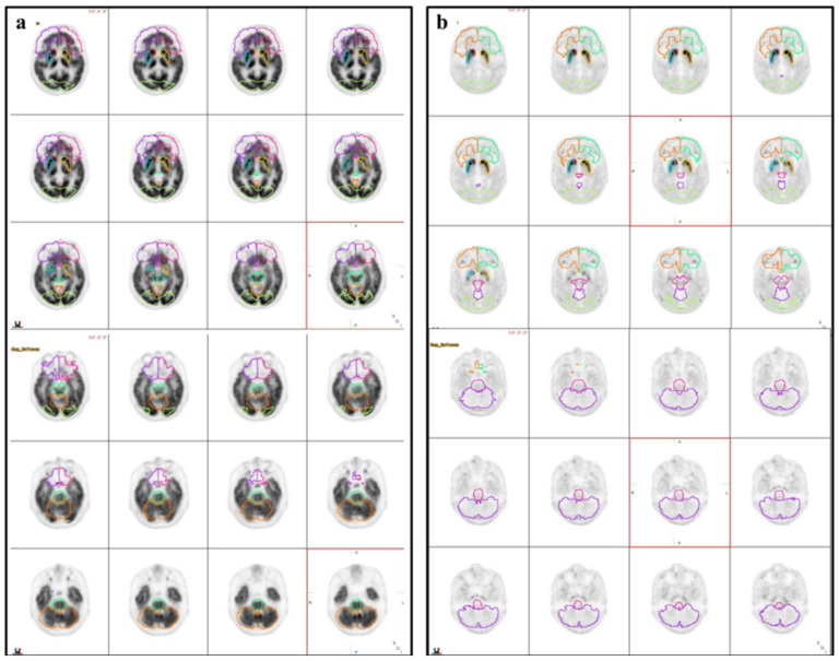 Illustration of volumes of interest (VOIs). Three-dimensional iso-contouring VOIs were automatically placed on the early (a) and late (b) phases of the 18F-FP-CIT PET/CT.