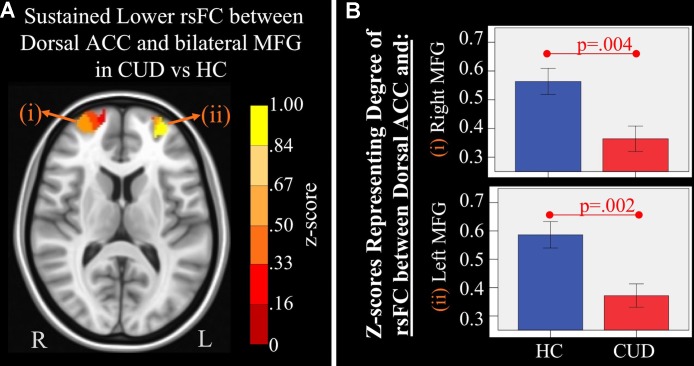 Main effect of group of dorsal anterior cingulate cortex (ACC) resting-state functional connectivity (rsFC) identified by a 2 × 2 mixed-model (group × time) analysis controlling for alcohol and nicotine. (A) LEFT: Axial Montreal Neurological Institute (MNI) brain slice (z = 11) illustrating clusters that showed a significant main effect of group in rsFC between the dorsal ACC seed and (i) right medial frontal gyrus (MFG; Brodmann area 10; 276 voxels) and (ii) left MFG (Brodmann area 10; 293 voxels). (B) RIGHT: Bar graphs representing mean (error bars: +/− 1 standard error) illustrating significant main effects characterized by lower rsFC between dorsal ACC and (i) right middle frontal gyrus (MFG) (F = 9.621, p = 0.004) and (ii) left MFG (F = 11.278, p = 0.002) in individuals with cannabis use disorder (CUD) than healthy controls (HC) across time.