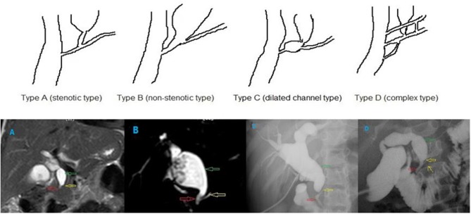 Different types of PBM. (A) stenotic type, (B) non-stenotic type, (C) dilated channel type, and (D) complex type. The common channel (the red hollow arrow), the pancreatic duct (the yellow hollow arrow), and the dilated bile duct (the green hollow arrow). In the type D PBM, there was a accessory pancreatic duct (the yellow arrow).