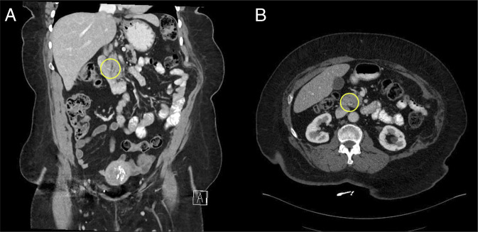 Computed tomography image showing linear hypodensity traversing the wall of the second portion of the duodenum and extending to the pancreatic head and traversing the pancreatic duct (A) coronal plane (B) axial plane.