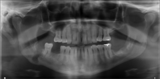 Patient B. Nonhealing extraction site #32, with radiolucent area affecting inferior border and tooth #31