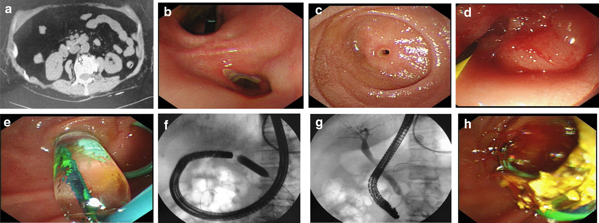 Imaging data for the patient. a Abdominal computed tomography showed a high density stone in CBD; b endoscopic view of gastric ulcer in pylorus; endoscopic appearance of a duodenal diaphragm with a 2 mm aperture, close view (c) and endoscopic dilatation view (d); e endoscopic view of balloon catheter in situ; f radiographic image of balloon dilatation. g After dilatation of diaphragm in the lumen, endoscopic tube passed through the stricture, ERCP radiography presented a 1 mm stone in CBD; h stone was pulled out through basket