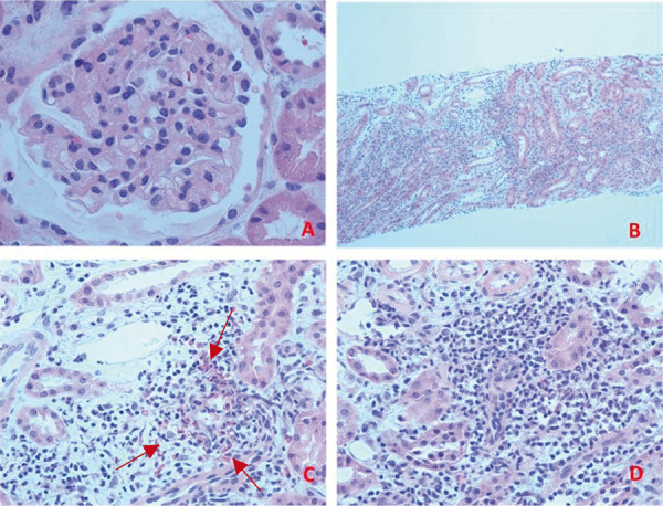 A: Glomerulus showing normal cellularity (H & E 40 × 10). B: Severe interstitial inflammation at cortico-medullary junction (H & E 10 × 10). C: Interstitial inflammation with many eosinophils (H & E 40 × 10). Arrows show many eosinophils identified by bilobed nuclei and characteristic red granular cytoplasmic stain. D: Interstitial inflammation and tubulitis (H & E 40 × 10).