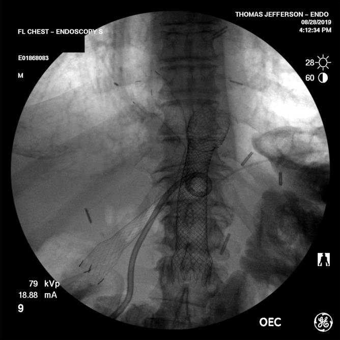A FCSEMS placed across the DJ into the efferent limb, and a second FCSEMS placed into the afferent limb. The percutaneous interventional radiology drain is also seen. FCSEMS, fully covered self-expanding metal stent.