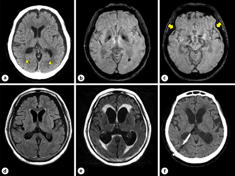 Brain images. Brain CT 3 days after brain trauma. Arrowheads show mild intraventricular hemorrhage (a). SWI of brain MRI 5 days after brain trauma reveals mild SAH with intraventricular hemorrhage (b). Arrows show a small amount of SAH around the Sylvian fissure (c). FLAIR sequence image detects normal ventricular size (d). FLAIR sequence image 33 days after brain trauma shows a prominent enlargement of the lateral ventricles and narrowing of the subarachnoid space (e). Brain CT 20 days after VP shunt (f). CT, computed tomography; FLAIR, fluid-attenuated inversion recovery; MRI, magnetic resonance imaging; SAH, subarachnoid hemorrhage; SWI, susceptibility-weighted image; T2WI, T2-weighted imaging; VP, ventriculoperitoneal.
