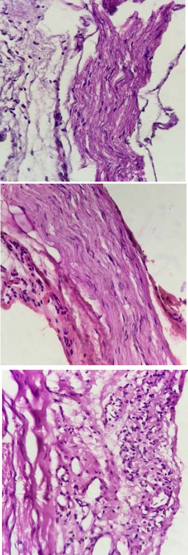 Cross sections of sciatic nerve from control (a), diabetic (b) and WIN 55, 212-2-treated animals (c and d). An increase in cellular infiltration and edema are seen in the diabetic rats. Treated animals show reduction in cellular infiltration, lack of destruction and damaged nerve cells, lack of necrosis and apoptosis and increasing microvessels