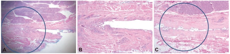 (A, B) Normal histology of the sphincter of Oddi at the oral protrusion inside the muscle layer of the duodenum. The bile duct was surrounded by the dense and thick sphincter of Oddi (A, H&E stain, ×40; B, H&E stain, ×100). (C) Normal histology of the bile duct outside the duodenal wall (H&E stain, ×100). The bile duct is surrounded by the rough and thin sphincter of Oddi, which has partly disappeared on the side of the parenchyma of the pancreas. The blue and translucent circle, 8 mm in diameter, denotes maximal inflation of the balloon.