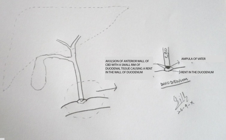 Figure 3: A line diagram illustrating the avulsion of anterior wall of CBD and duodenal rent.