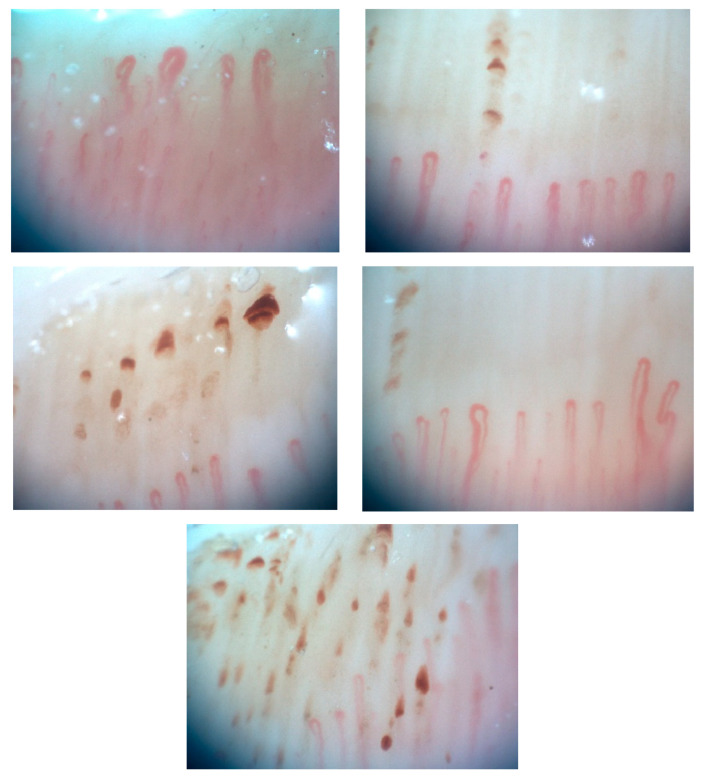 Nail-fold capillaroscopy shows multiple giant capillaries, dilated capillary loops, and areas of capillary hemorrhage with capillary drop-out. Patient consent was obtained.
