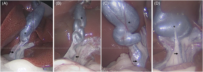 Biliary morphology was classified based on the degree of cystic duct dilatation. Cases in which the minor axis of the cystic duct (*) was ≤3.4 times the minor axis of the common bile duct (arrow) were placed in the mild dilatation group and those in which the minor axis of the cystic duct (*) was ≥3.5 times the minor axis of the common bile duct (arrow) were placed in the severe dilatation group. The mild dilatation group (A, B) had 27 of the 52 cases, whereas the severe dilatation group (C, D) had 25 cases. The photographs show 2 examples from each group