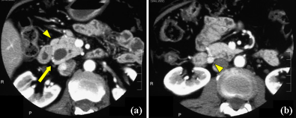 Contrast-enhanced CT shows the markedly dilated CBD and 2 enlarged lymph nodes in the peripancreatic region. (a) The marked dilated CBD (arrow) and one of 2 enlarged lymph nodes near the upper border of the pancreas (arrow head) are detected. (b) Another enlarged lymph node near the lower border of the pancreas (arrow head) is found.