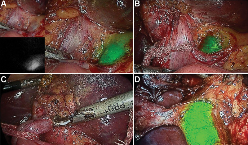 (a) ICGF showing CBD location in an obscure hepatocystic triangle with a choledochoduodenal fistula; pure laparoscopic, NIRF and NIRFA images in the left upper corner, left lower corner and right side respectively; (b) Cholecystoduodenal fistula dissection and looping aided by real-time NIRFA-CBD; (c) Cholecystoduodenal fistula takedown in progress; (d) ICGF demonstrating critical view of safety after fistula takedown. CBD = common bile duct, ICGF = ICG fluorescence, NIRF = near-infrared fluorescence, NIRFA = near infrared fluorescence augmented.