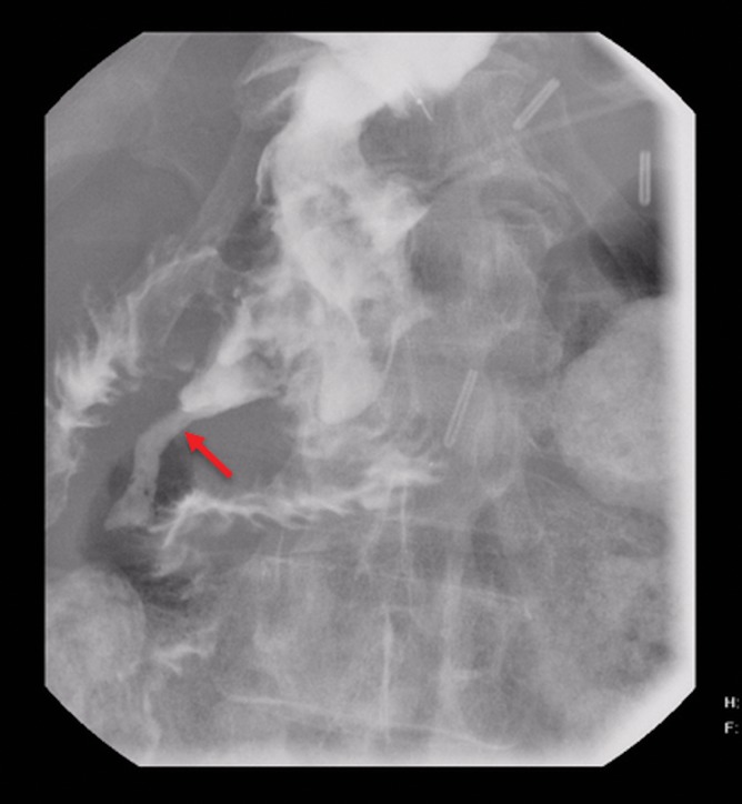 UGI series showing DJ leak (arrow). UGI, upper gastrointestinal.
