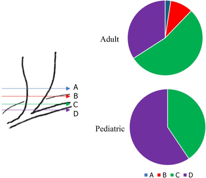 Results of the nationwide expert survey of adult and pediatric institutions on the duodenal‐side transection line in fusiform‐type CBD. The transection lines were categorized as A–D: A (blue line), dilated portion; B (red line), upper margin of the pancreas; C (green line), intrapancreatic bile duct; and D (purple line), just above the confluence of the pancreaticobiliary junction.
