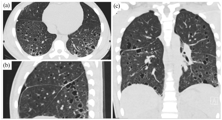 (a) Axial, (b) sagittal, and (c) coronal images from non-contrast chest computed tomography showing innumerable thin-walled cysts throughout the lung parenchyma bilaterally, in a subpleural and lower lobes predominant distribution. No discrete lung nodules seen.
