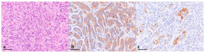 Histopathological and immunohistochemical findings: (a) the tumour is highly cellular with a small lobular pattern surrounded by a thin fibrovascular stroma (haematoxylin and eosin, bar = 50 µm); (b) tumour cells are diffusely immunopositive for synaptophysin (immunohistochemistry, bar = 50 µm); and (c) tumour cells are partially immunopositive for gastrin (immunohistochemistry, bar = 50 µm)