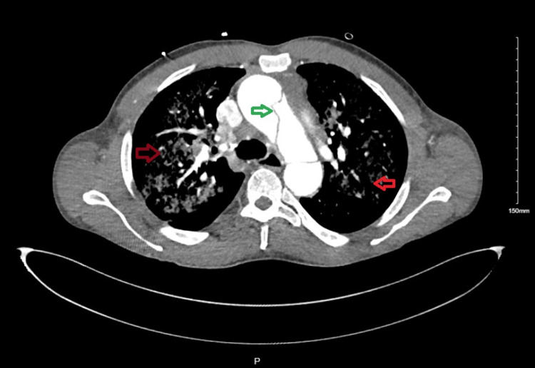 CTA of the chest - transverse planeGreen arrow - acute type A aortic dissection involving the ascending aorta extending into the left subclavian artery and descending aorta. Red arrows - extensive ground glass opacities present in all lobes of the lungsCTA: computed tomography angiography