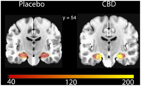 Differences in hippocampal CBF after CBD or placebo.This coronal slice highlights differences in grey matter perfusion in the hippocampus (in green). Scale bar units = mL/100 g/min. MNI coordinate displayed.