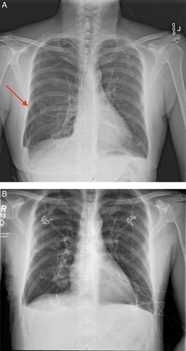 (A) Moderate sized right pneumothorax on presentation (left). (B) Resolution of right-sided pnseumothorax.