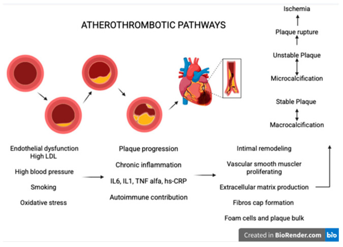 Mechanism of atherosclerosis in AMI; created with BioRender.com. version 4.0.