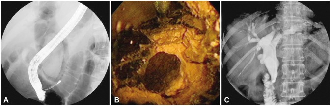 (A) Endoscopic retrograde cholangiopancreatography showing a giant common bile duct (CBD) stone with markedly dilated CBD. (B) Cholangioscopy showing a fragmented stone by electrohydraulic lithotripsy. (C) Cholangiogram showing clear removal state of a previously giant CBD stone.
