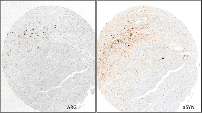 Micro-ARG in Substantia nigra brain section from a PD donor with [3H]KAC-50.1 revealed accumulation of silver grains on Lewy bodies but not Lewy Neurites.