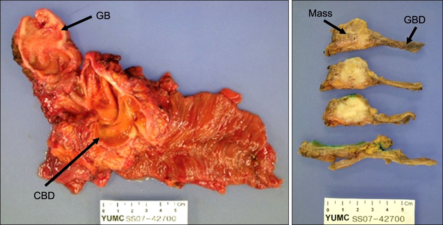 Specimens from patient before and after fixation. The common bile duct (CBD) is markedly dilated, measuring 7 cm in inner circumference and 6.5 cm in length. Opening along the CBD revealed an ill-defined mass measuring 2 × 1.5 cm. The gallbladder shows an ill-defined thickened wall area in the fundus measuring 3 × 3 cm. GB, gallbladder.