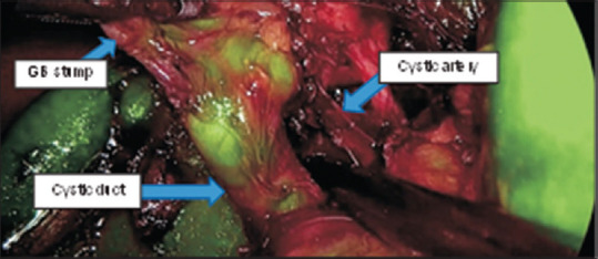 A critical view of safety being achieved. Blue arrows show cystic artery, cystic duct and gall bladder stump- Together forming the critical view of safety. GB: Gall bladder