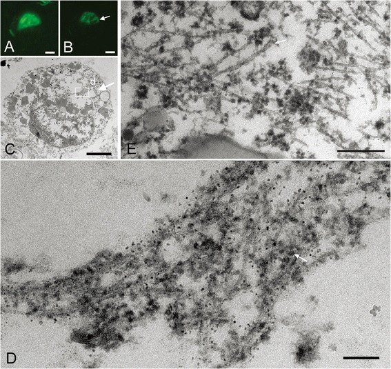 Correlation of immunolabeled LM and EM images of Pick-like inclusions in two CBD cases. A densely packed round inclusion (Pick-like inclusion) from a CBD case (case 3) labeled with anti-PHF antibody (AT8) visualized with QD 655, also labeled with Alexa 488 for more precise confocal images (A). Correlated LM and EM images (B, C) showed that tau immunoreactivity around the cavity on LM corresponded to bundles of tau filaments that were not arranged as parallely as in AD (C, rectangle d; D). Note that these filaments were intermingled with ribosomes (D, arrow). (E) The ultrastructure of Pick-like inclusions in another case of CBD (case 4) also revealed randomly assembled tau filaments with occasional formation of paired helical filaments (a periodicity of 130 nm, arrow). Scale bars in A to C = 3 μm; D = 50 nm; E = 100 nm. A to D, case 3; E, case 4.
