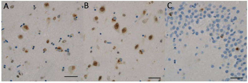 TDP-43 pathology in the limbic system. (A,B) Case 10 (clinical phenotype, PSPS; pathological phenotype, PSP-like). (C) Case 6 (clinical phenotype, PSPS; pathological phenotype, PSP-like). Several TDP-43 positive inclusions are shown in the amygdala (A) and the entorhinal cortex (B). Their nuclei are negative for TDP-43 immunoactivity. Several TDP-43-positive intracytoplasmic inclusions are shown in the hippocampal granule cells (C). (A–C) TDP-43. Scale bars: (A–C) 20 μm.