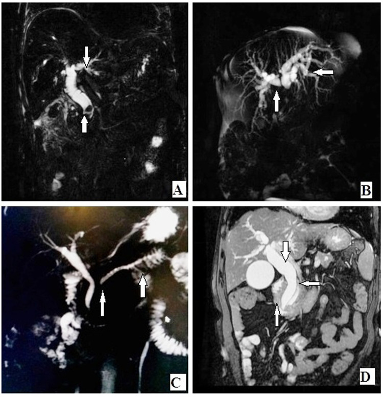 (A) Coronal MIP reformat showing CBD calculus at distal end with proximal obstructive bile duct dilatation. (B) Coronal MIP reformat showing hilar mass lesion with proximal bile duct dilatation and non-confluence of right and left hepatic ducts. (C) Coronal MIP reformat showing stricture of MPD with upstream dilatation in a case of chronic pancreatitis. (D) Coronal T2-weighted fat-saturated image showing neoplastic mass of periampullary region with stricture of distal CBD and distal MPD and dilatation of proximal pancreatic duct and proximal CBD and IHBR. CBD, common bile duct; MIP, maximum intensity projection; MPD, Main pancreatic duct; IHBR, Intrahepatic biliary radicals.