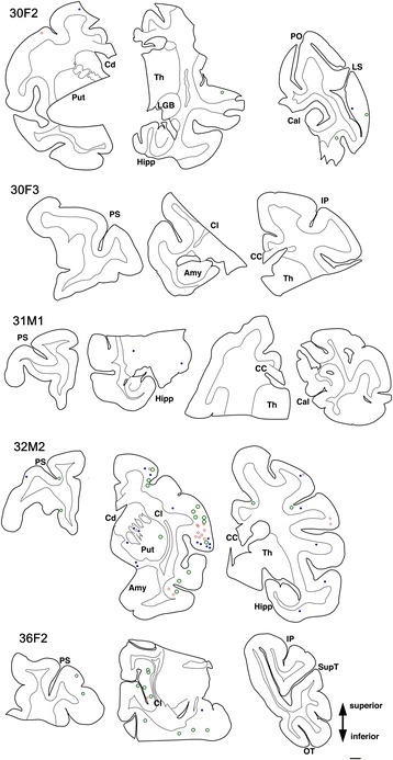 Frontal-dominant distribution of tau-positive neurons and glia. AT8-positive structures were plotted onto coronal slices with astrocytic signals labeled as green rings, neuronal signals labeled as red rings and signals in oligodendroglial cells labeled as blue spots. Slices are displayed from the left (anterior) to the right (posterior), with Case IDs indicated for each row (eg, “30 F2” indicates “30-year-old female, case no 2”). AT8-positive lesions were detectable after age 30, but these were few in number. These lesions were predominantly in the neocortex rather than in the hippocampus. Amy:amygdala; Cal:calcarine sulcus; CC:corpus callosum; Cd:caudate nucleus; Cl:claustrum; Hipp:hippocampus; IP:intraparietal sulcus; LGB:lateral geniculate body; LS:lunate sulcus; PO:parietooccipital sulcus; PS:principal sulcus; Put:putamen; SupT:superior temporal sulcus; OT:occipitotemporal sulcus; Th:thalamus; Scale bar, 2 mm