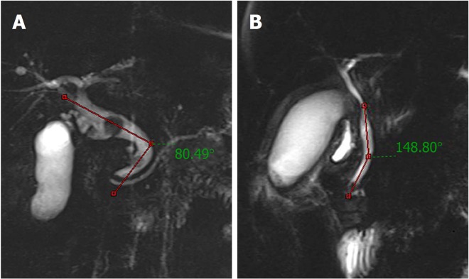Distal common bile duct angulation measured based on magnetic resonance cholangiopancreatography. A: A case with acute distal common bile duct angulation (< 145°); B: A case without acute distal common bile duct angulation (> 145°).
