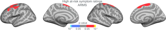 Significant grey matter thickness differences between highly symptomatic ARMS and their HC counterpart using a frontal–temporal mask. As part of the post-hoc analysis a FWHM of 15 mm was used in this case rather than 20 mm. Multiple comparison correction was performed using permutation testing of 100,000 tests with a cluster-forming threshold of p < .05 and cluster-wise threshold of p < .05 with an additional Bonferroni correction to take both hemispheres into account. The clusters in the left and right superior frontal regions have a p = .024 and p = .033 respectively. (Red = greater grey matter thickness in HC compared to the high symptomatic ARMS)