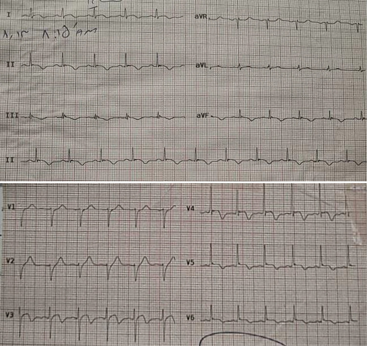 The electrocardiogram during the follow-up showing the evolution of the changes in the same territories.