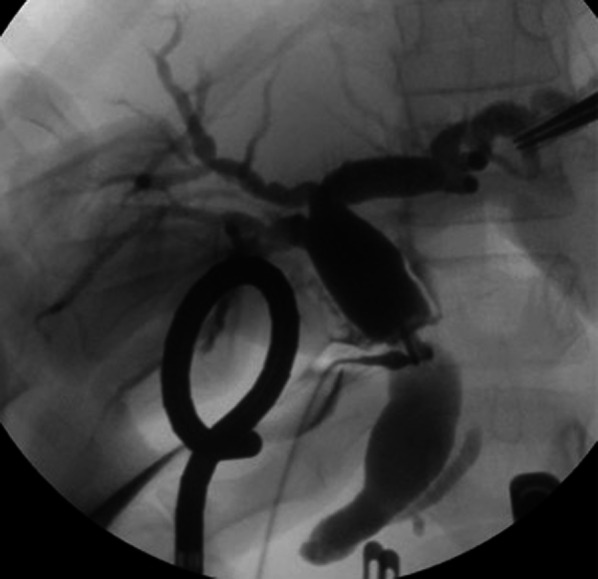 Intraoperative cholangiography. Intraoperative cholangiography performed by direct puncture of the dilated common bile duct does not show the gallbladder or the cystic lesion in the hepatic hilum. The anterior and posterior segment branches separately join the common hepatic duct